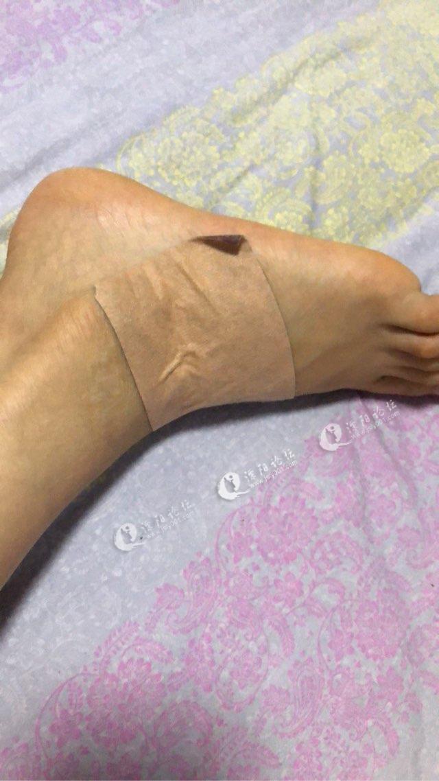 老婆昨晚下楼时,不小心把脚扭伤了.
