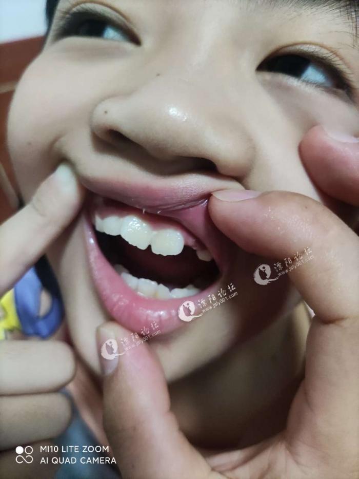 十岁小女孩,牙齿整形去哪个医院好点,大概多少钱