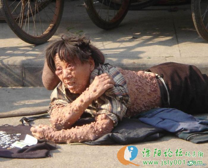 回复引用 煤建路甘氏皮肤病门诊,专业治疗:牛皮癣,白癜风,痤疮(青春